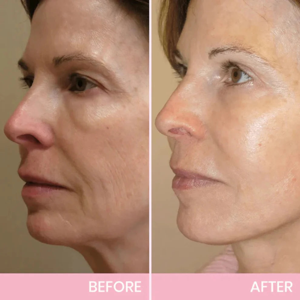 ContourVeil™ Face Lift Film